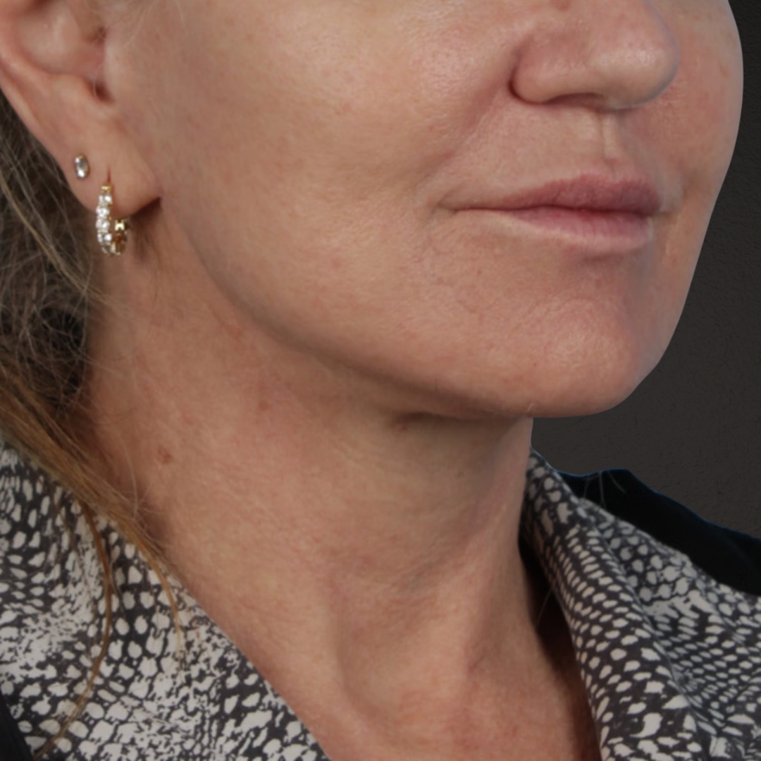 Facelift Before & After Gallery - Patient 315359 - Image 4