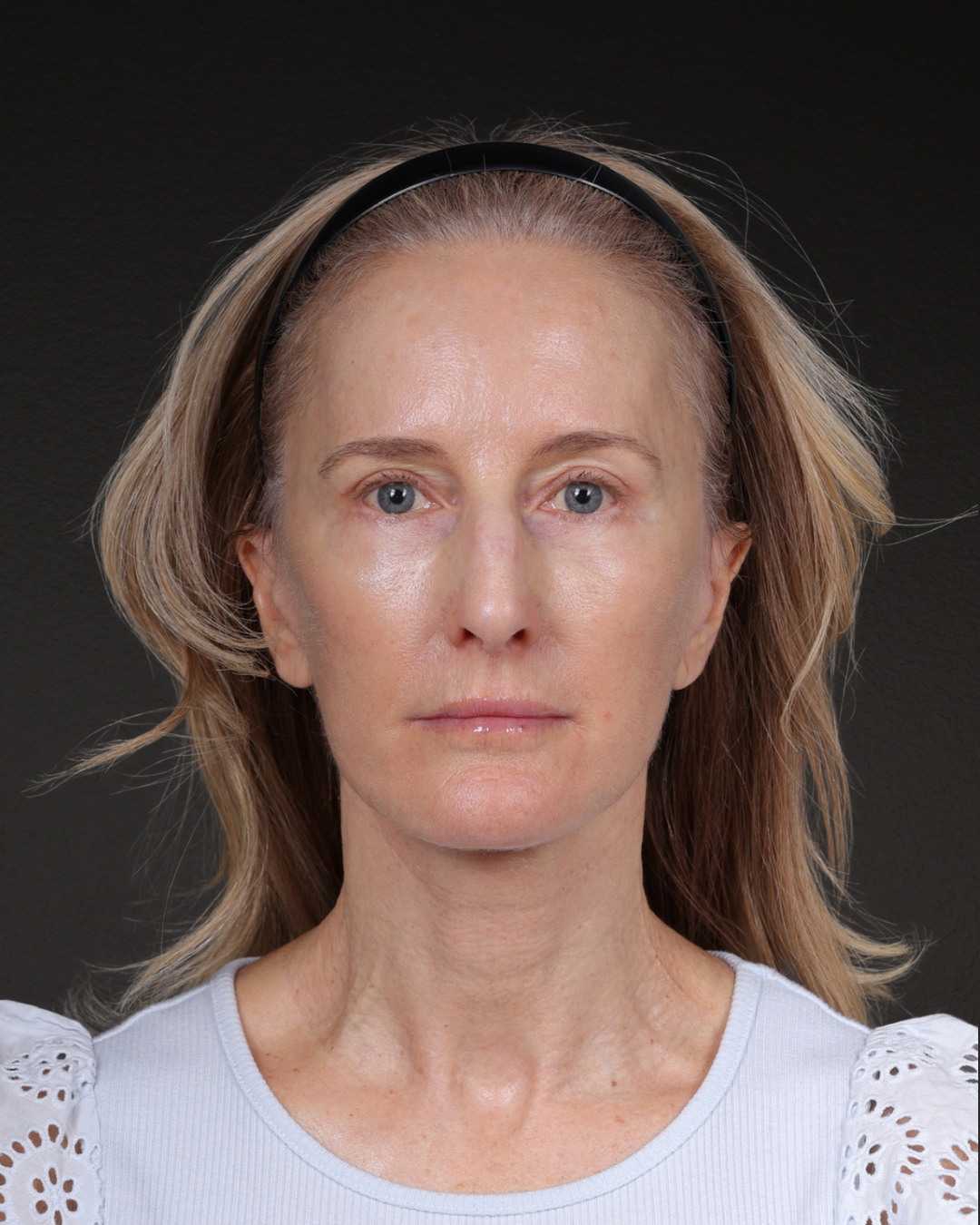 Facelift Before & After Gallery - Patient 401503 - Image 6