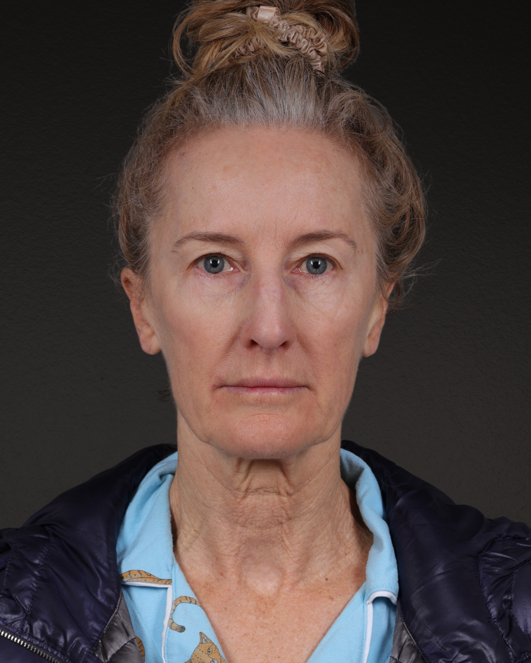 Facelift Before & After Gallery - Patient 401503 - Image 5