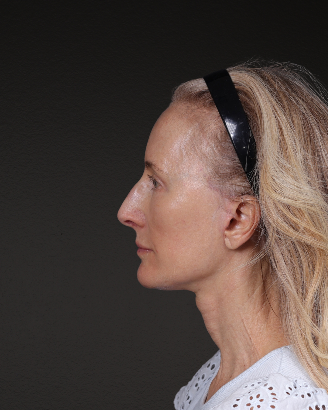 Facelift Before & After Gallery - Patient 401503 - Image 10