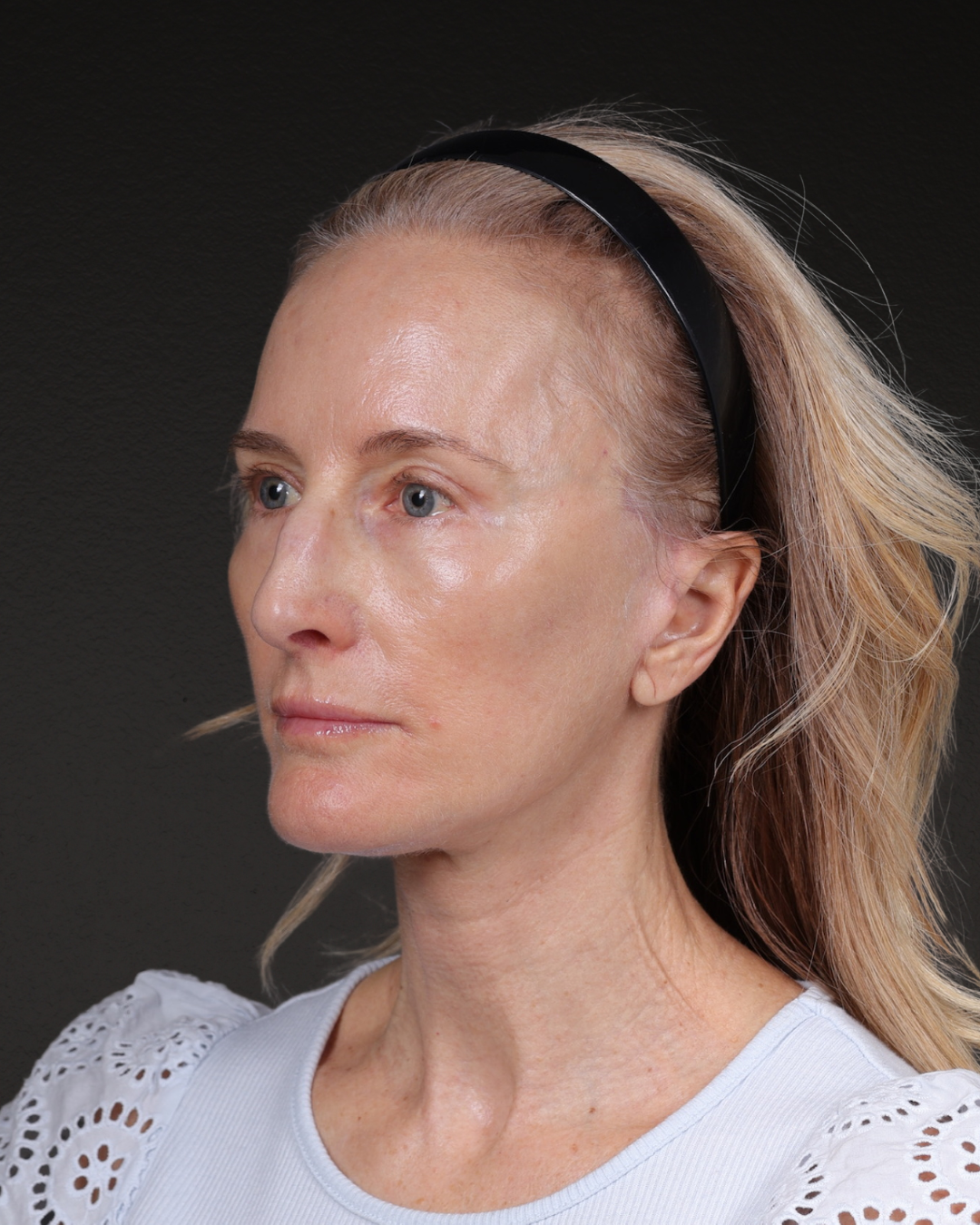 Facelift Before & After Gallery - Patient 401503 - Image 8