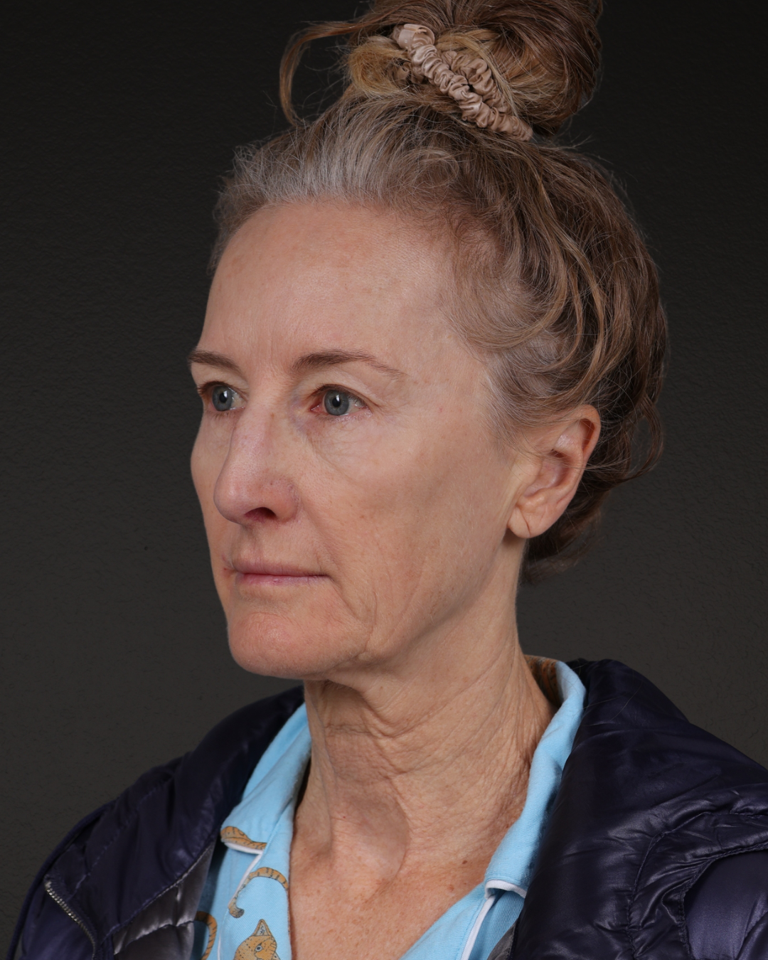 Facelift Before & After Gallery - Patient 401503 - Image 7