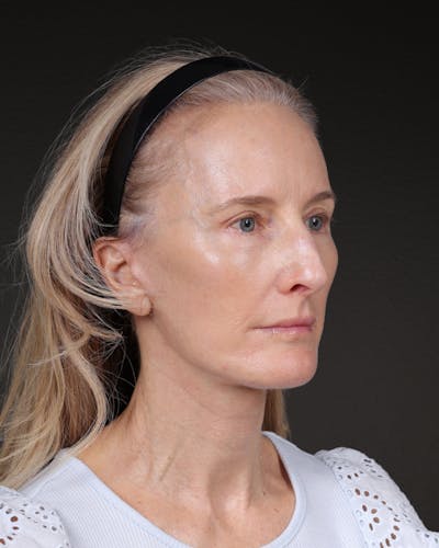 Co2 Laser Before & After Gallery - Patient 497723 - Image 2