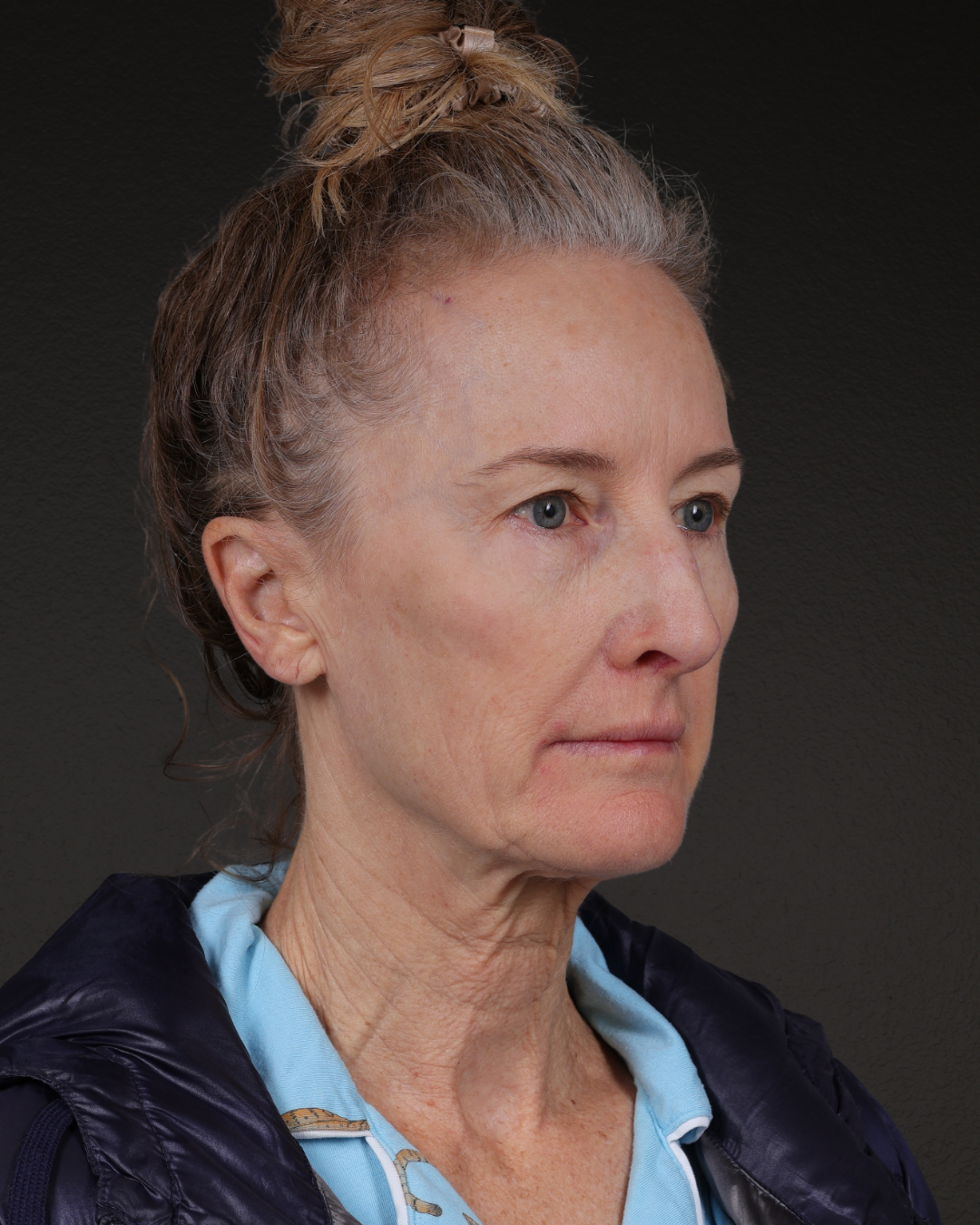 Facelift Before & After Gallery - Patient 401503 - Image 1