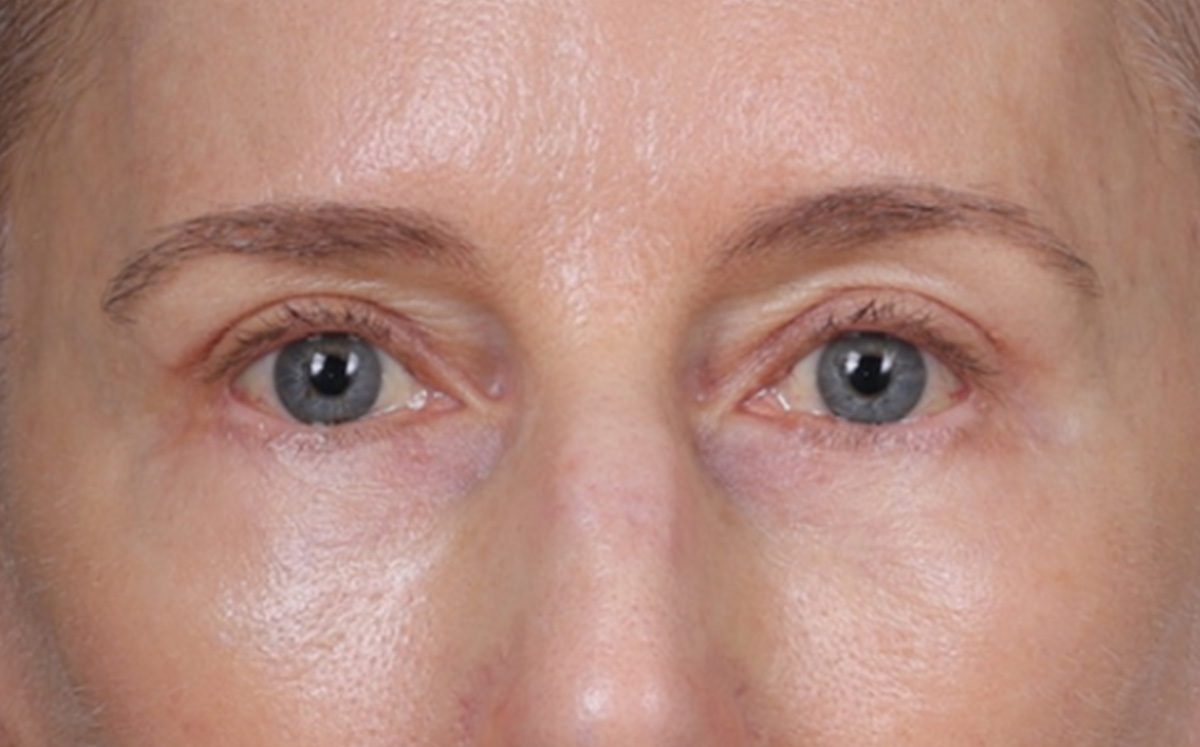 Brow Lift Before & After Gallery - Patient 123386 - Image 2