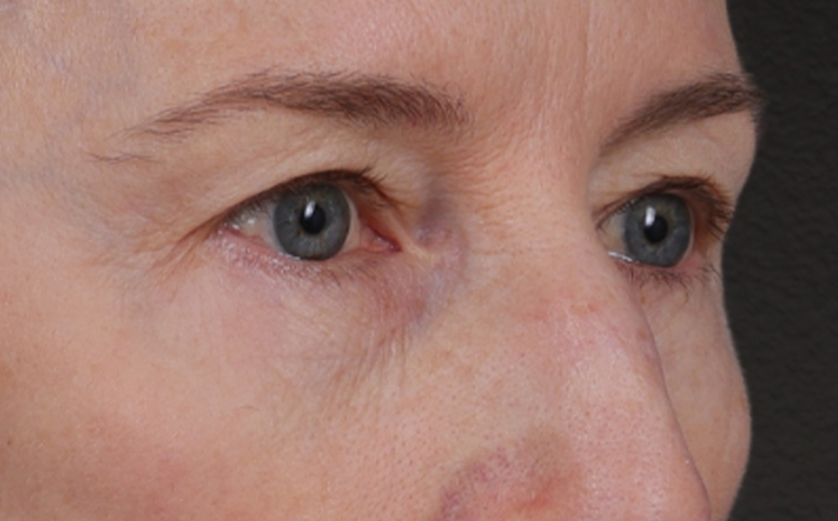 Brow Lift Before & After Gallery - Patient 123386 - Image 3