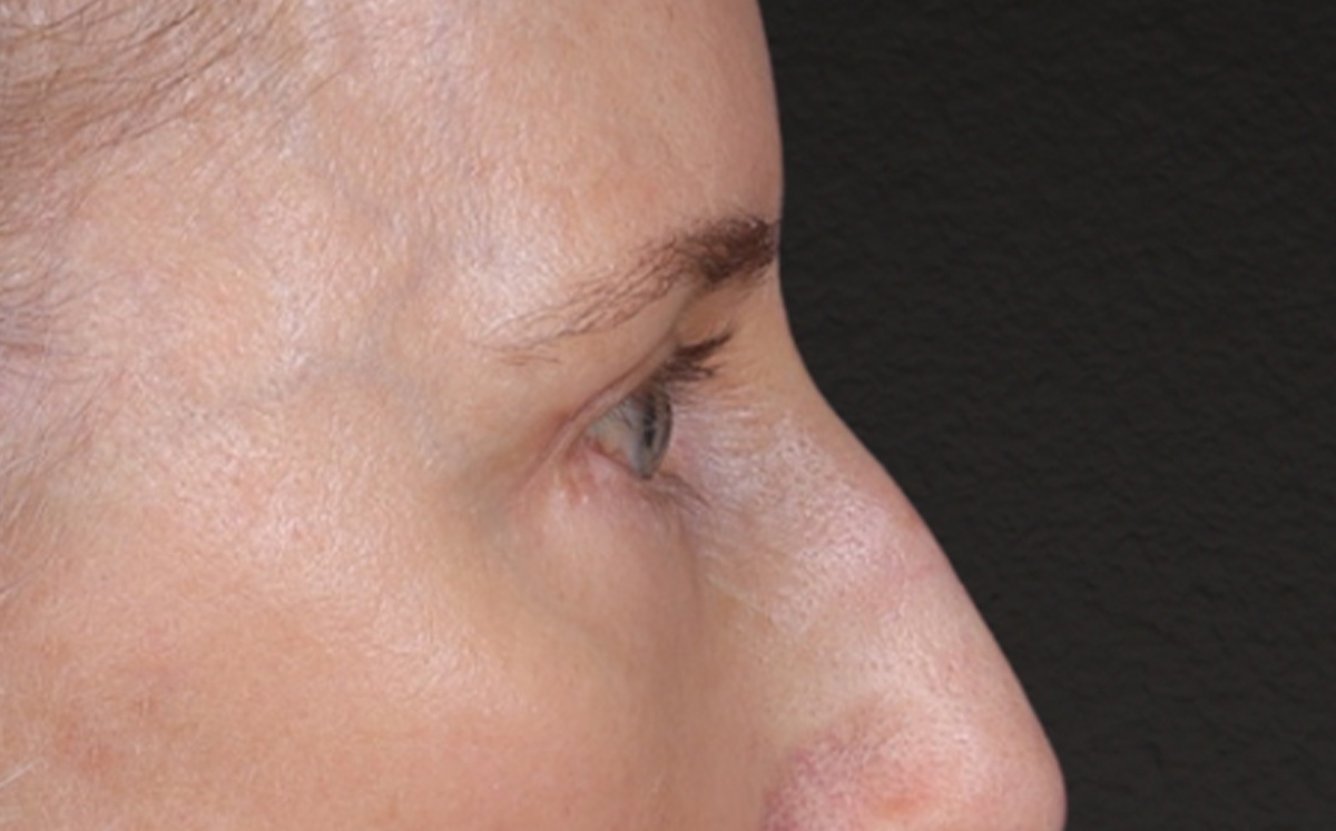 Brow Lift Before & After Gallery - Patient 123386 - Image 6
