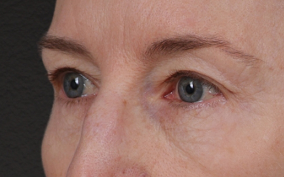 Brow Lift Before & After Gallery - Patient 123386 - Image 7