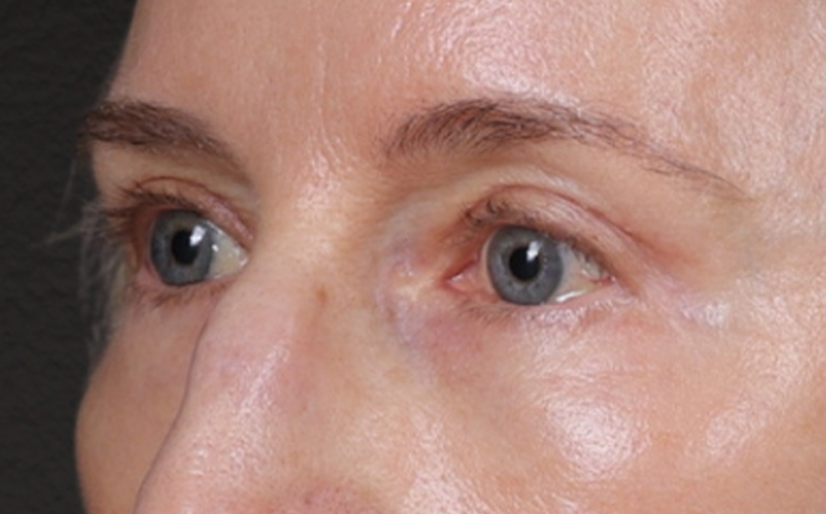 Brow Lift Before & After Gallery - Patient 123386 - Image 8
