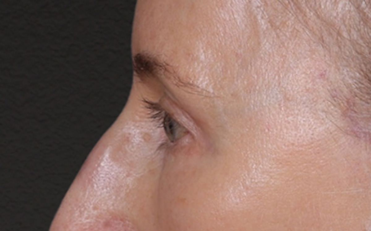 Brow Lift Before & After Gallery - Patient 123386 - Image 10
