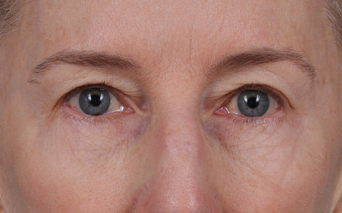 Brow Lift Before & After Gallery - Patient 123386 - Image 1