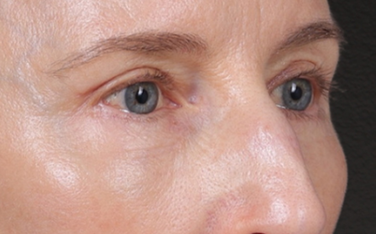 Brow Lift Before & After Gallery - Patient 123386 - Image 4
