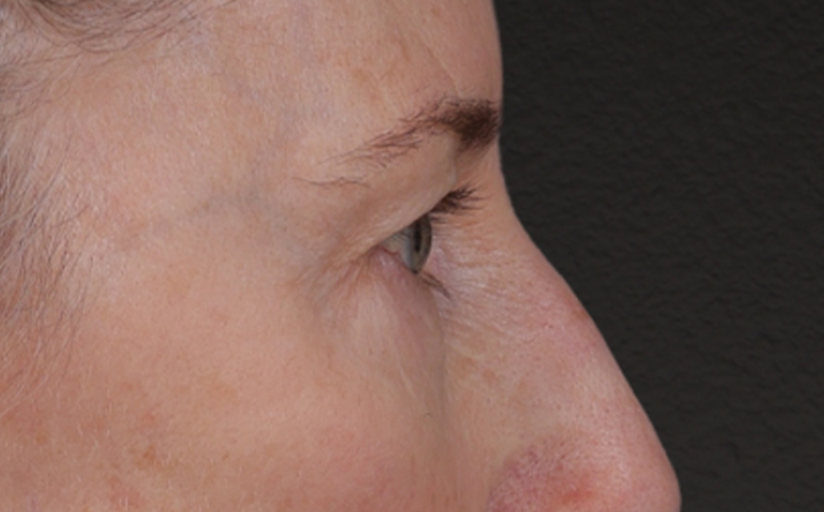Brow Lift Before & After Gallery - Patient 123386 - Image 5