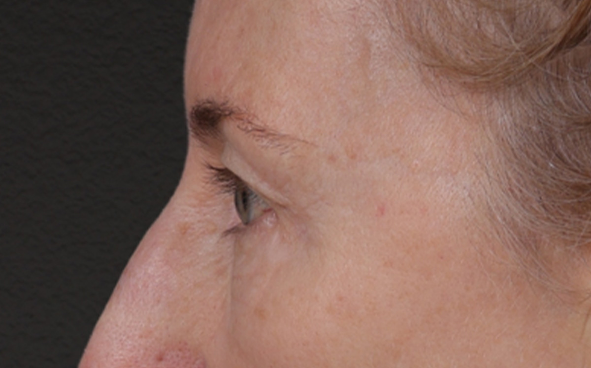 Brow Lift Before & After Gallery - Patient 123386 - Image 9