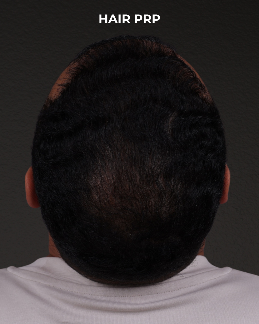 Hair Rejuvenation With PRP Before & After Gallery - Patient 233027 - Image 2