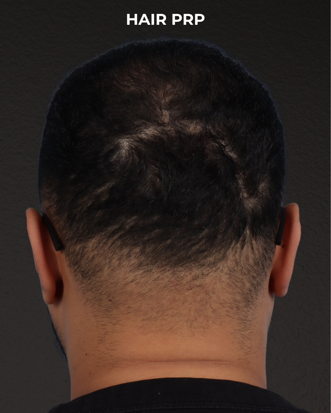 Hair Rejuvenation With PRP Before & After Gallery - Patient 233027 - Image 1