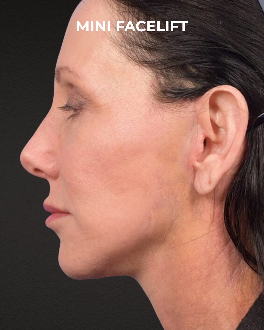 Facelift Before & After Gallery - Patient 325352 - Image 4