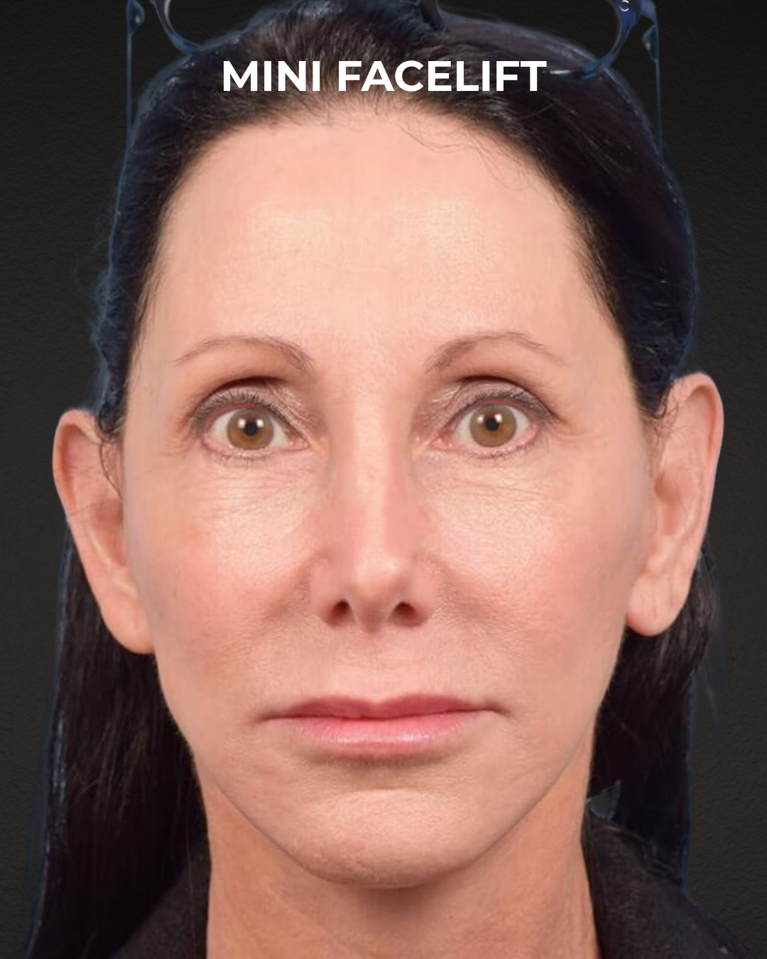Facelift Before & After Gallery - Patient 325352 - Image 6
