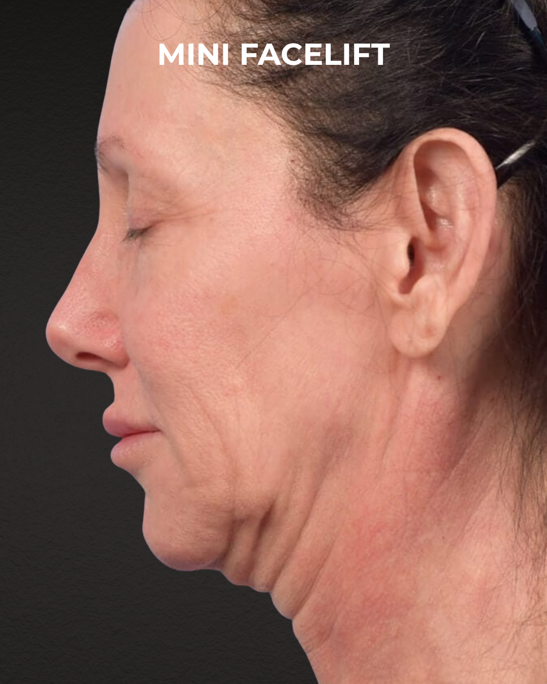 Facelift Before & After Gallery - Patient 325352 - Image 3