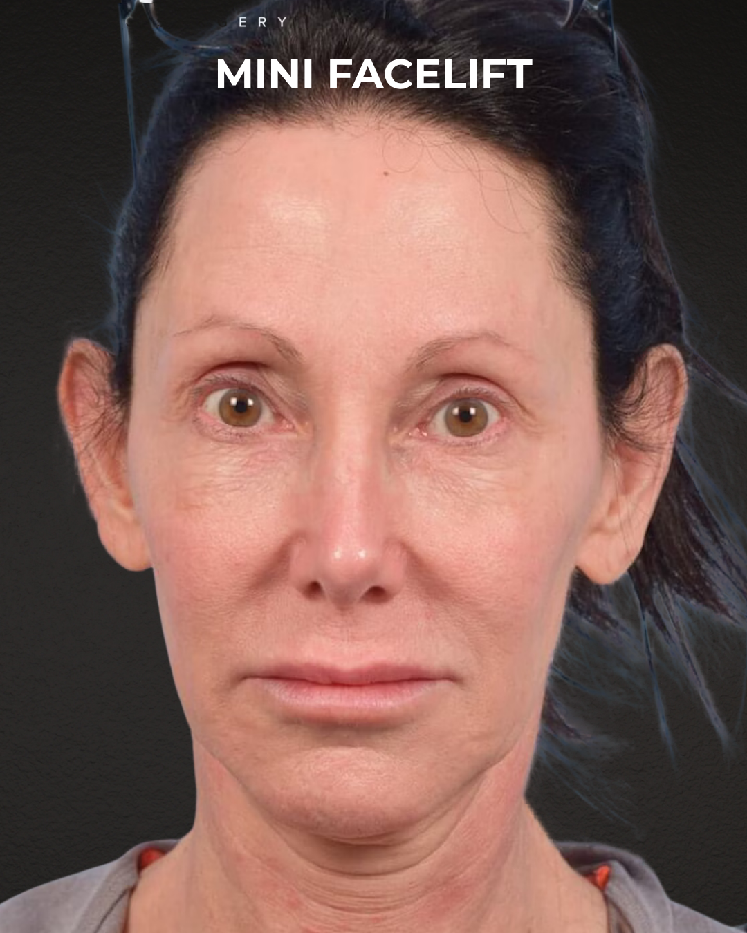 Facelift Before & After Gallery - Patient 325352 - Image 5