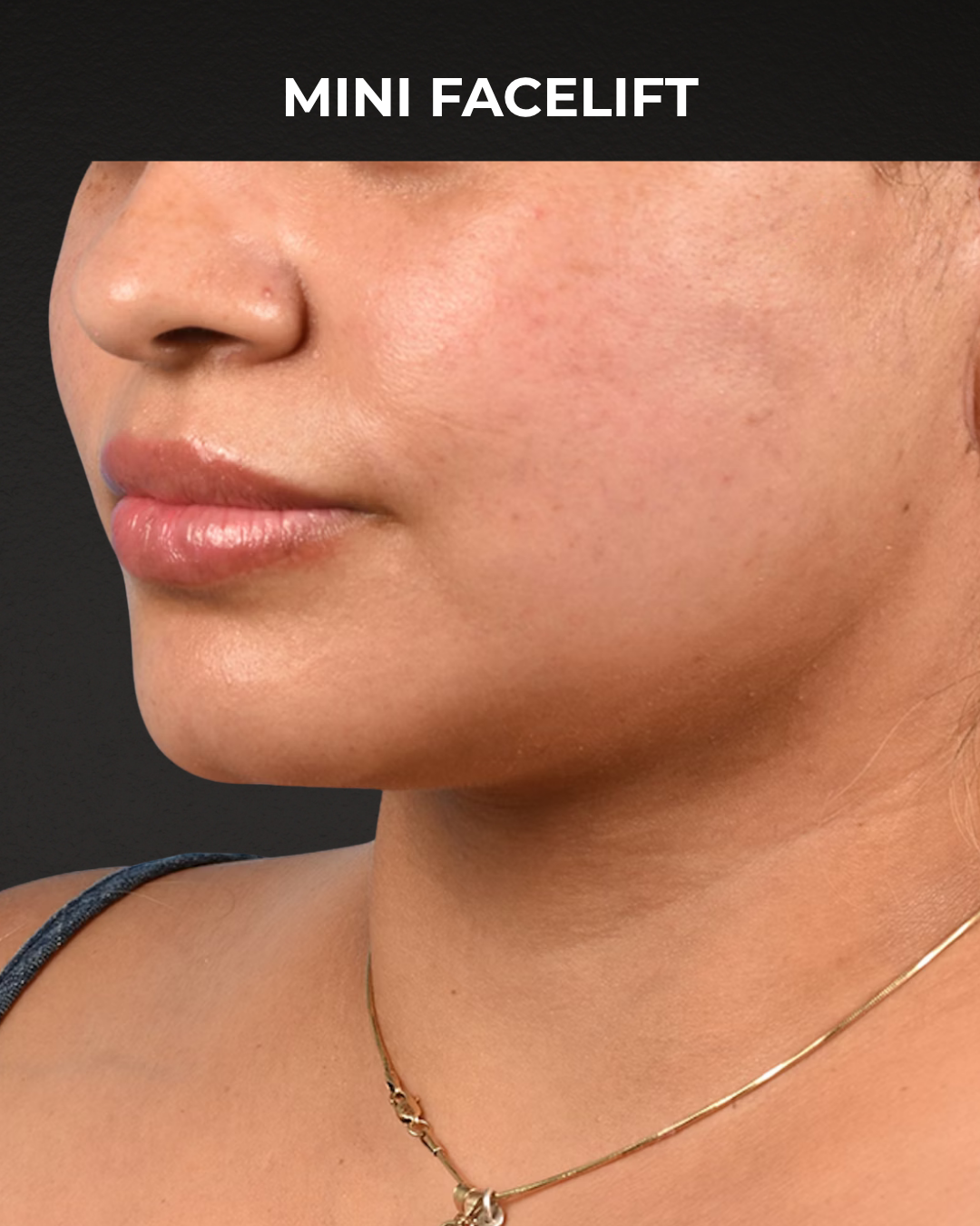 Facelift Before & After Gallery - Patient 508752 - Image 4