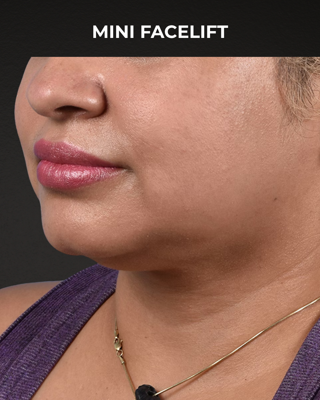 Facelift Before & After Gallery - Patient 508752 - Image 3