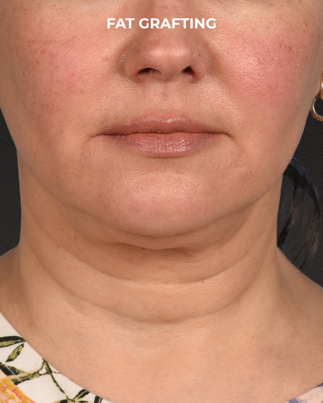 Fat Grafting Before & After Gallery - Patient 239537 - Image 1