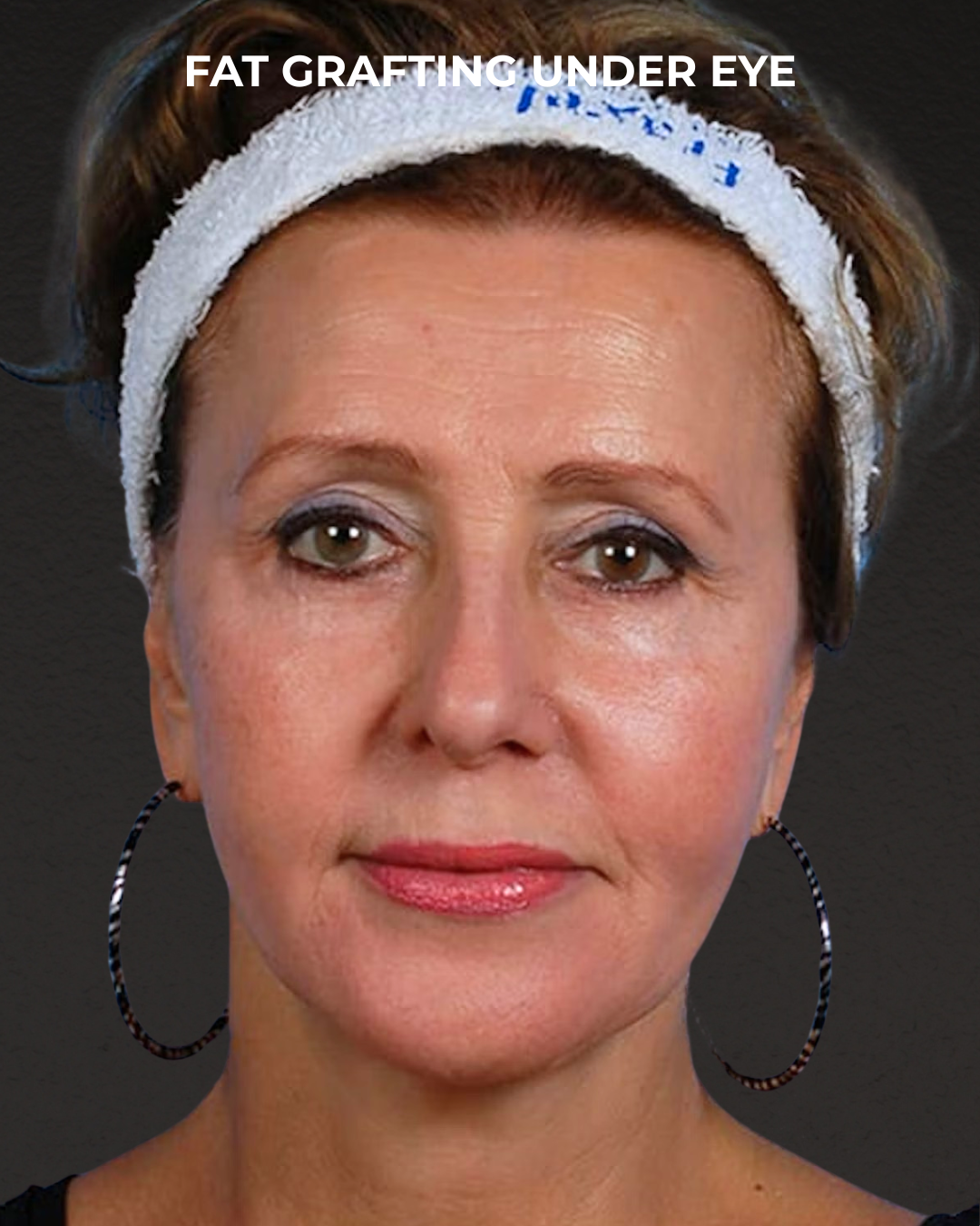 Fat Grafting Before & After Gallery - Patient 333366 - Image 2