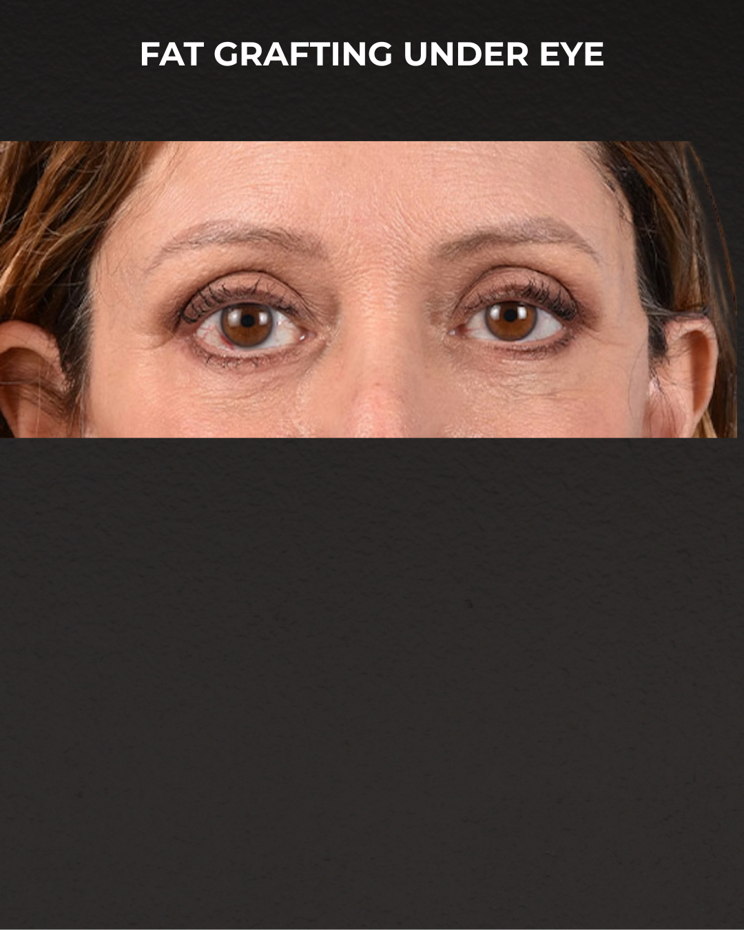 Fat Grafting Before & After Gallery - Patient 147269 - Image 2