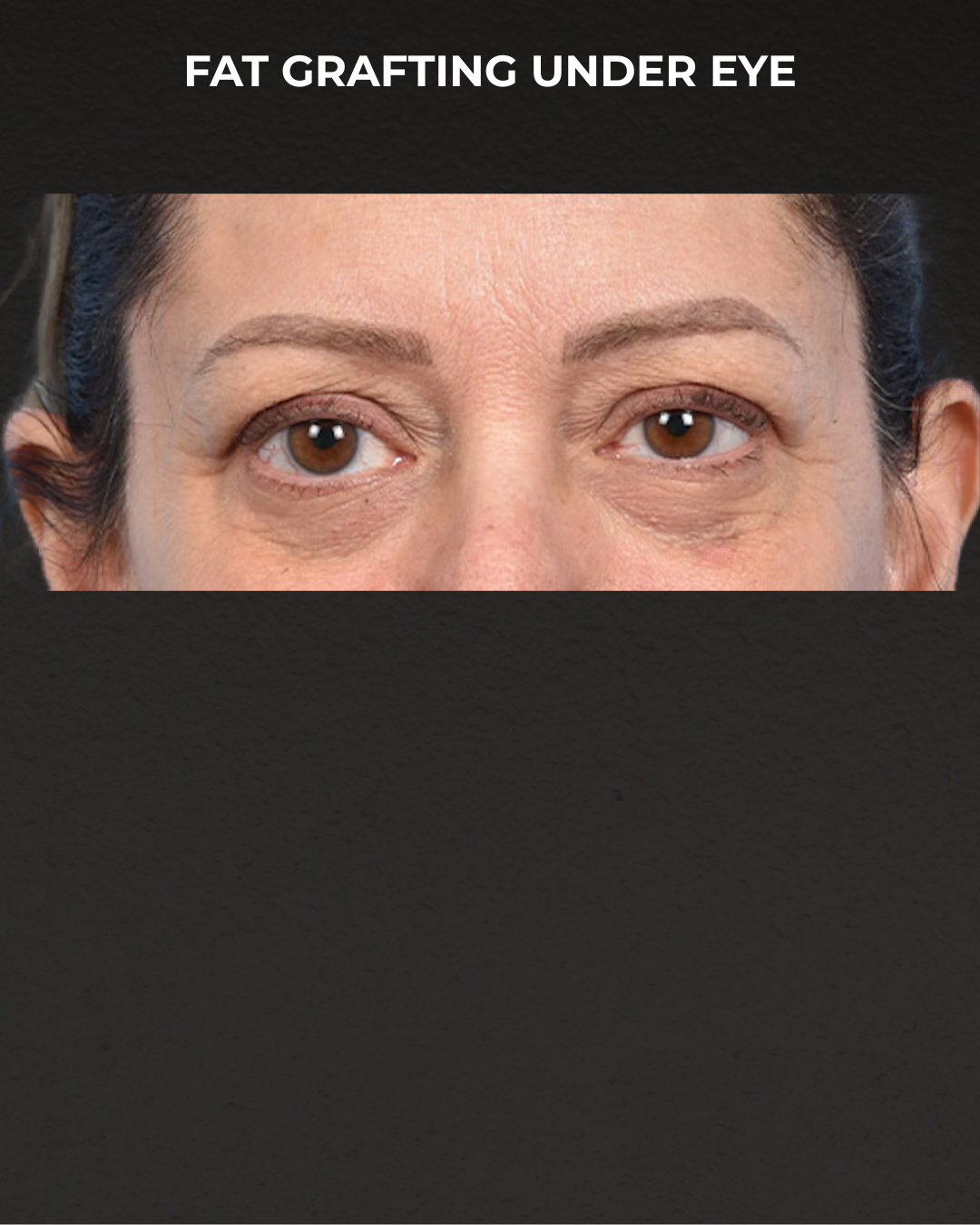 Fat Grafting Before & After Gallery - Patient 147269 - Image 1