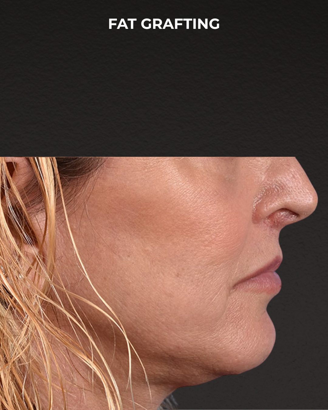 Fat Grafting Before & After Gallery - Patient 307741 - Image 4