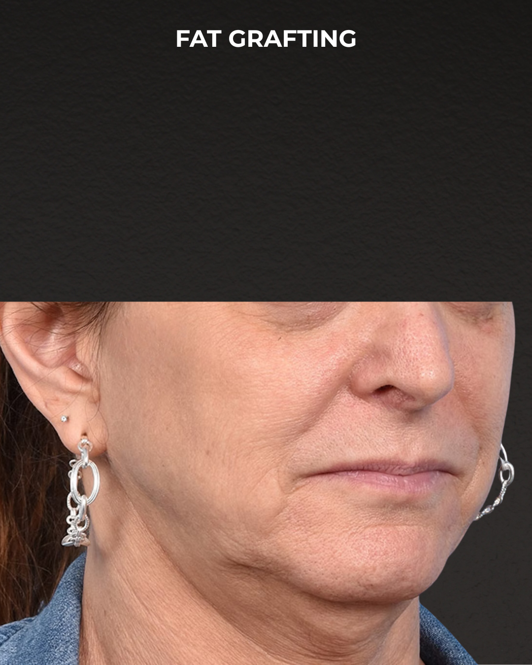 Fat Grafting Before & After Gallery - Patient 307741 - Image 5