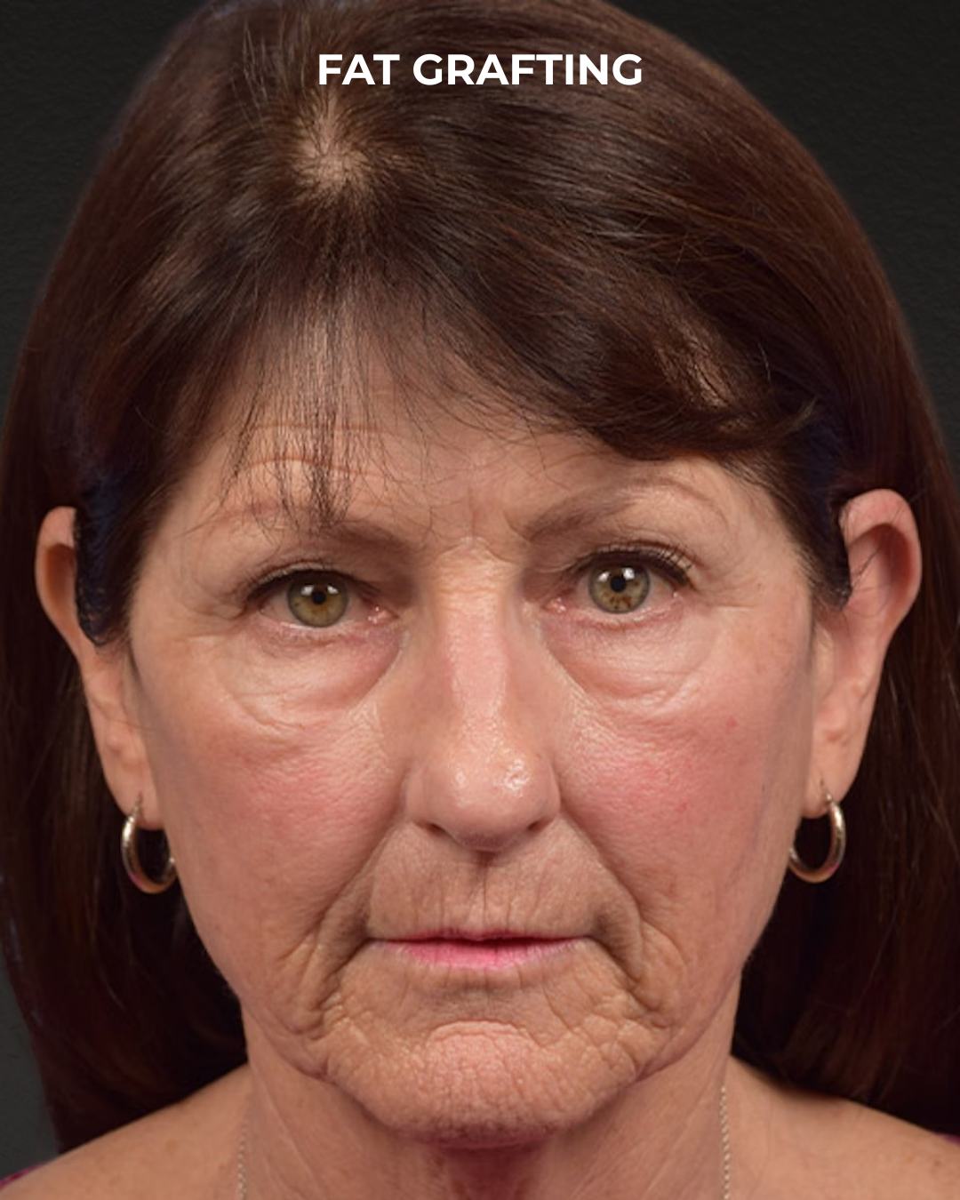 Fat Grafting Before & After Gallery - Patient 364651 - Image 1