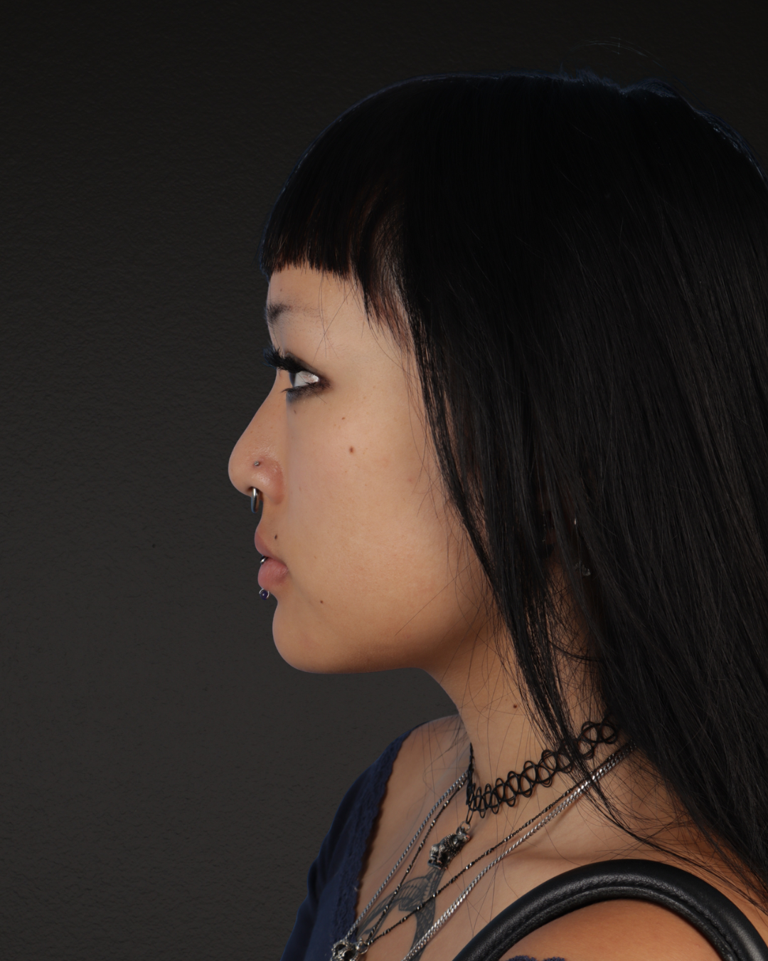 Rhinoplasty Before & After Gallery - Patient 113225 - Image 3