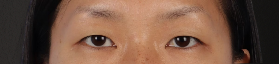 Blepharoplasty Before & After Gallery - Patient 871559 - Image 1