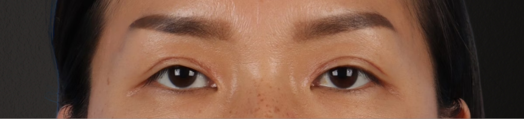 Blepharoplasty Before & After Gallery - Patient 871559 - Image 2