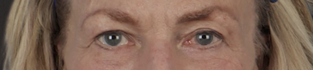 Blepharoplasty Before & After Gallery - Patient 912260 - Image 2
