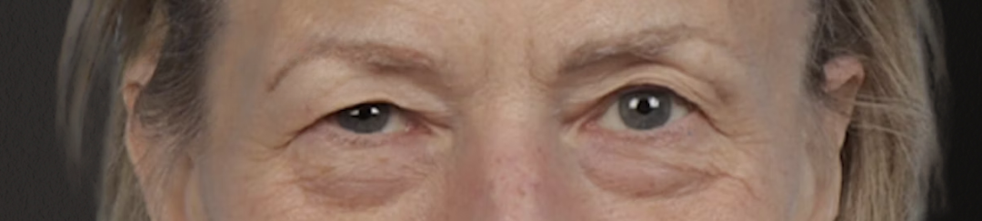 Blepharoplasty Before & After Gallery - Patient 912260 - Image 1