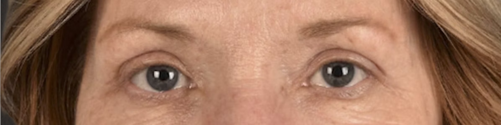 Blepharoplasty Before & After Gallery - Patient 943759 - Image 2