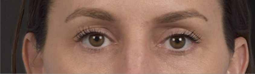 Blepharoplasty Before & After Gallery - Patient 117445 - Image 2