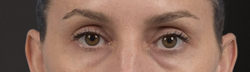 Blepharoplasty Before & After Gallery - Patient 117445 - Image 1