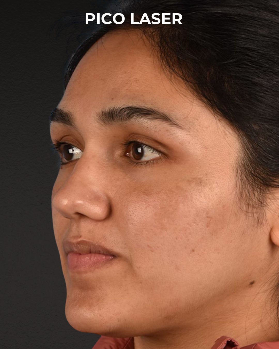 Pigment Laser Before & After Gallery - Patient 304638 - Image 4