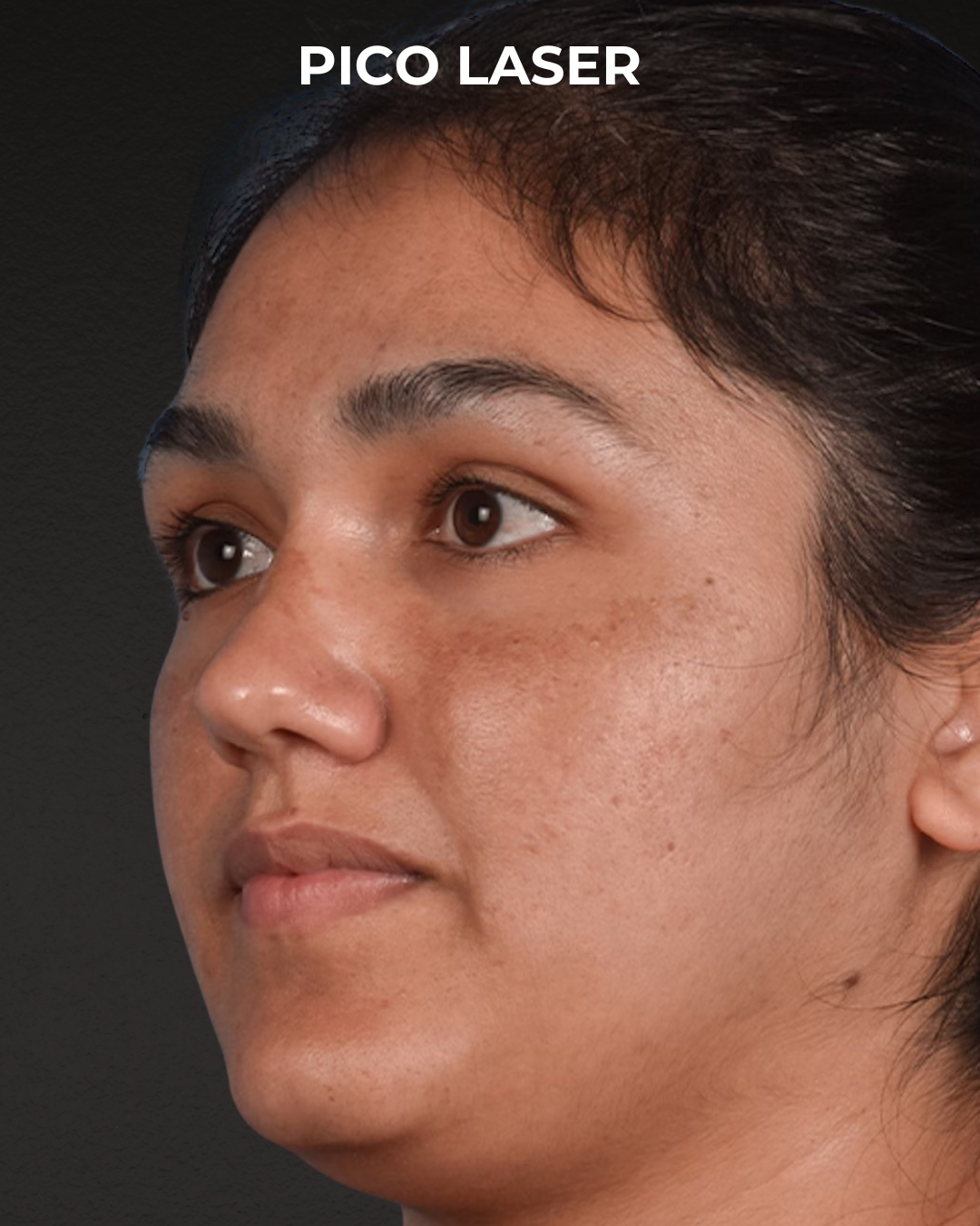 Pigment Laser Before & After Gallery - Patient 304638 - Image 3