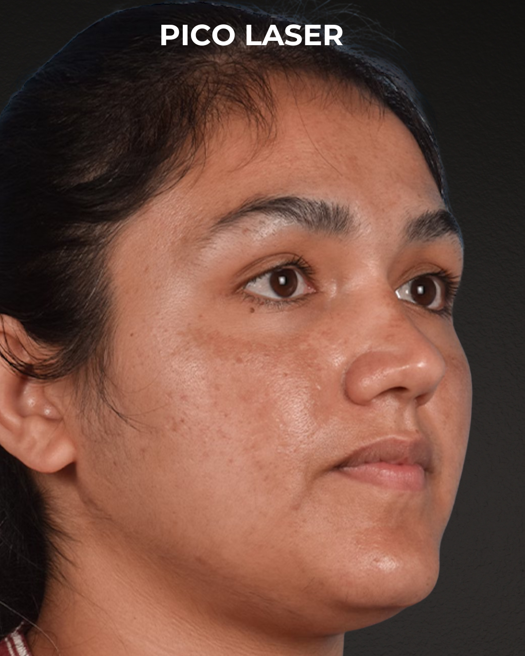 Pigment Laser Before & After Gallery - Patient 304638 - Image 5