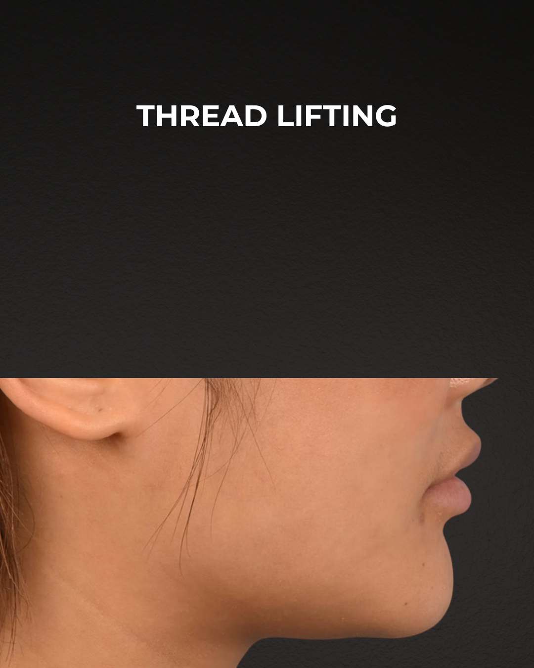 Thread Lifting Before & After Gallery - Patient 132694 - Image 6