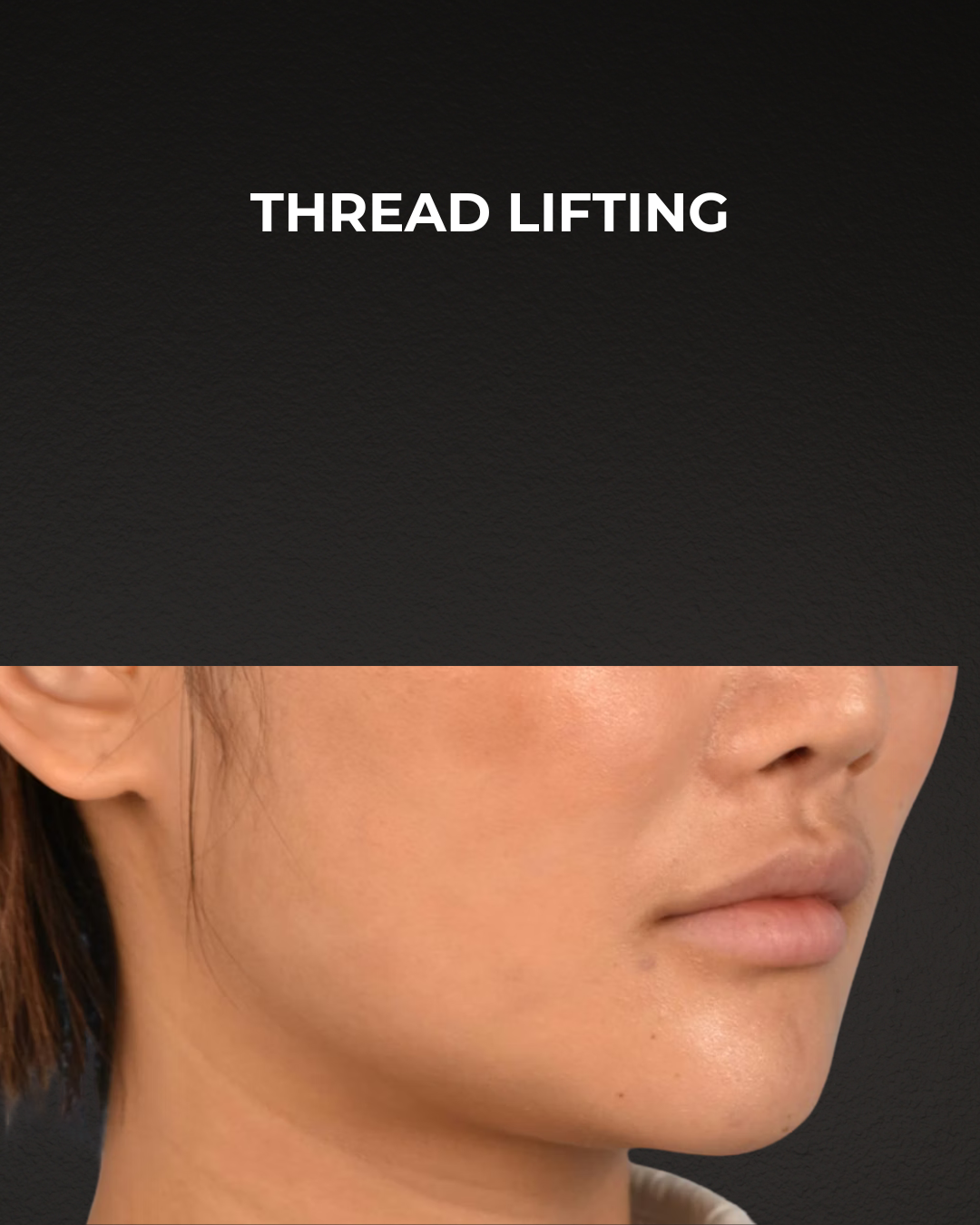 Thread Lifting Before & After Gallery - Patient 132694 - Image 4