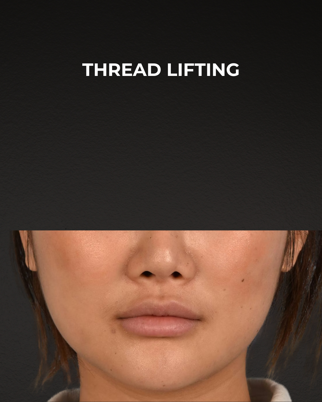 Thread Lifting Before & After Gallery - Patient 132694 - Image 2
