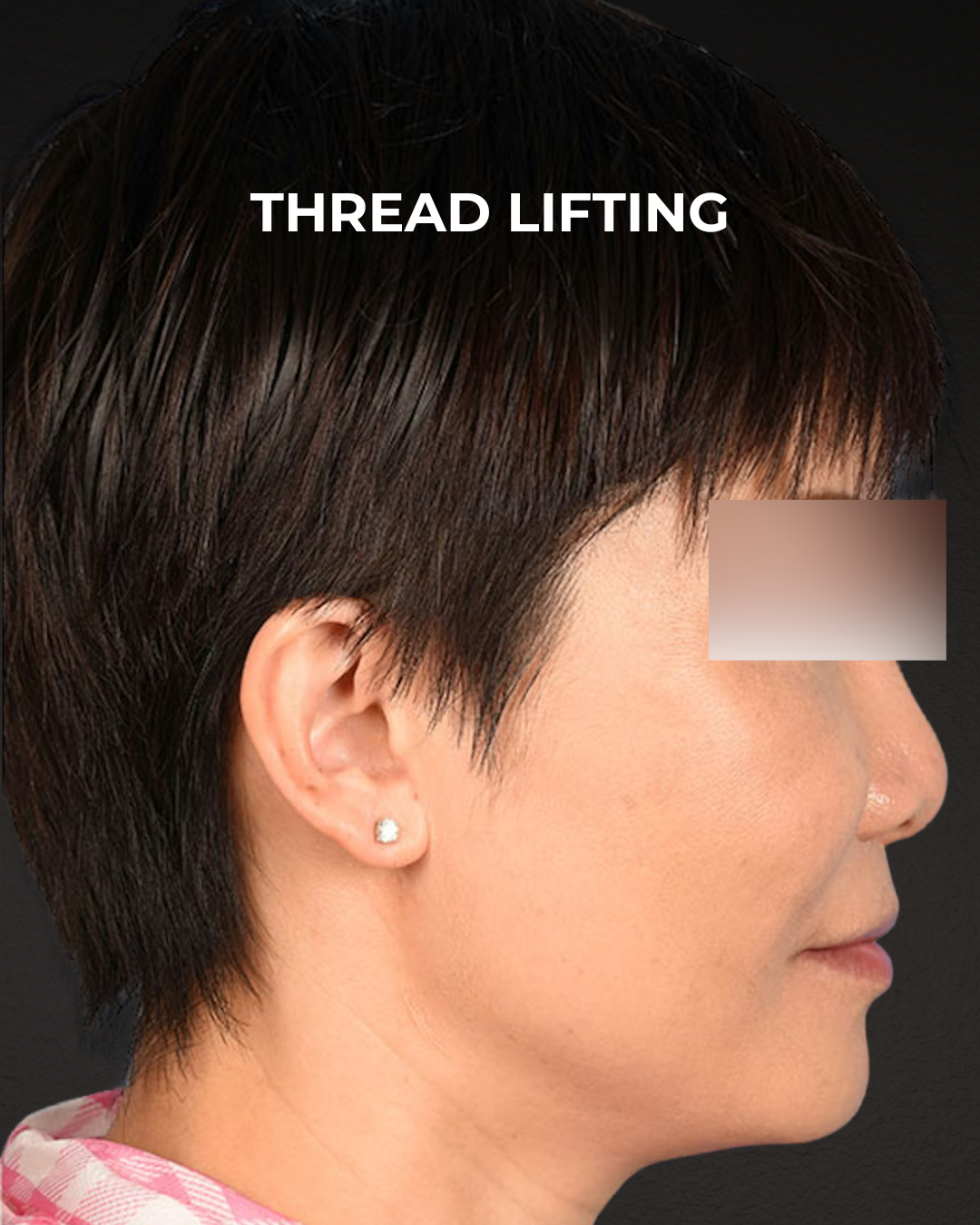 Thread Lifting Before & After Gallery - Patient 285819 - Image 4