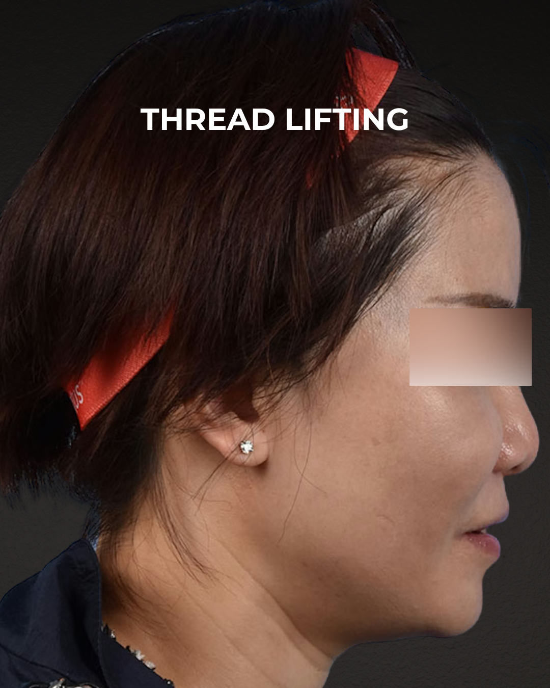 Thread Lifting Before & After Gallery - Patient 285819 - Image 3