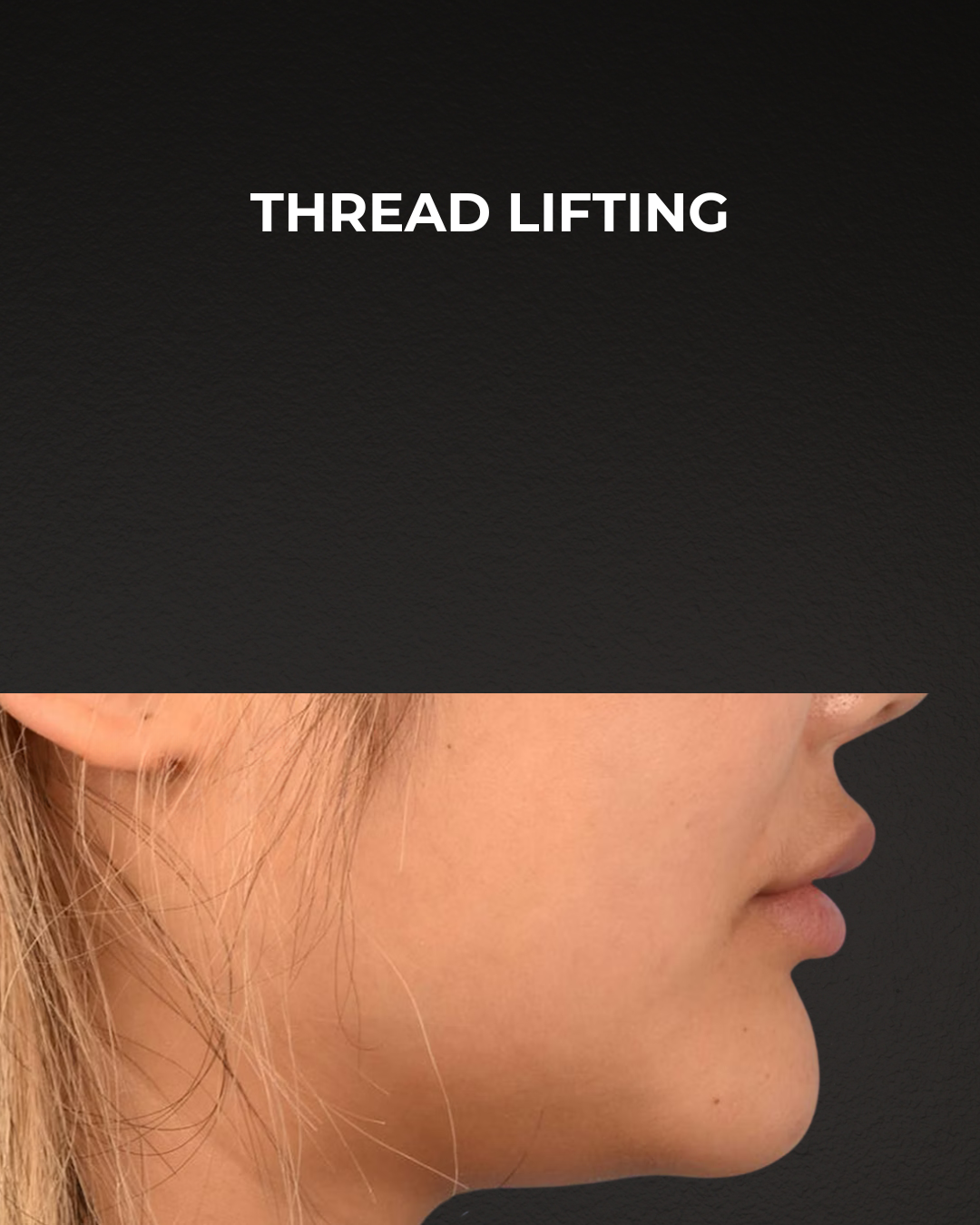 Thread Lifting Before & After Gallery - Patient 132694 - Image 5